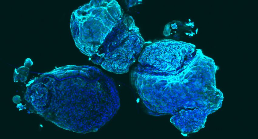Isolated airway stem cells from a lung cancer patient