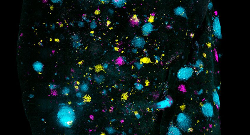 Multi-coloured tumours indicate cells invading a lung